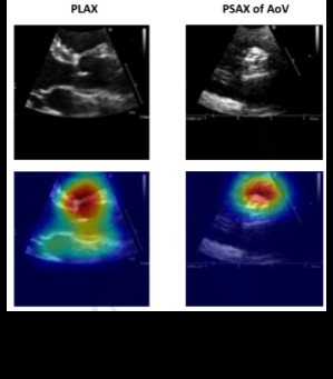 Grad-CAM heatmaps overlaid on PLAX and PSAX of AoV echocardiographic views, showing model attention regions.